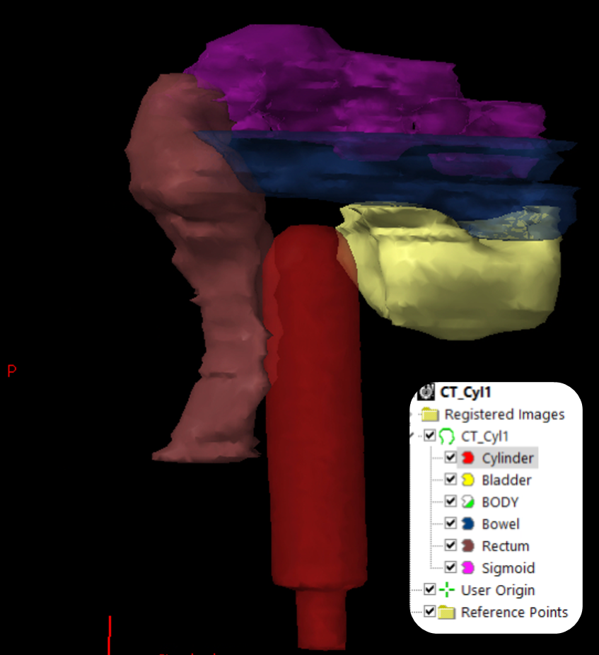 Bowel Bag Example